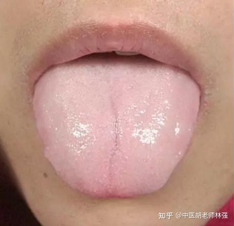 舌头边缘有齿痕?不一定是脾虚湿气重,中医教你三招解决齿痕舌 