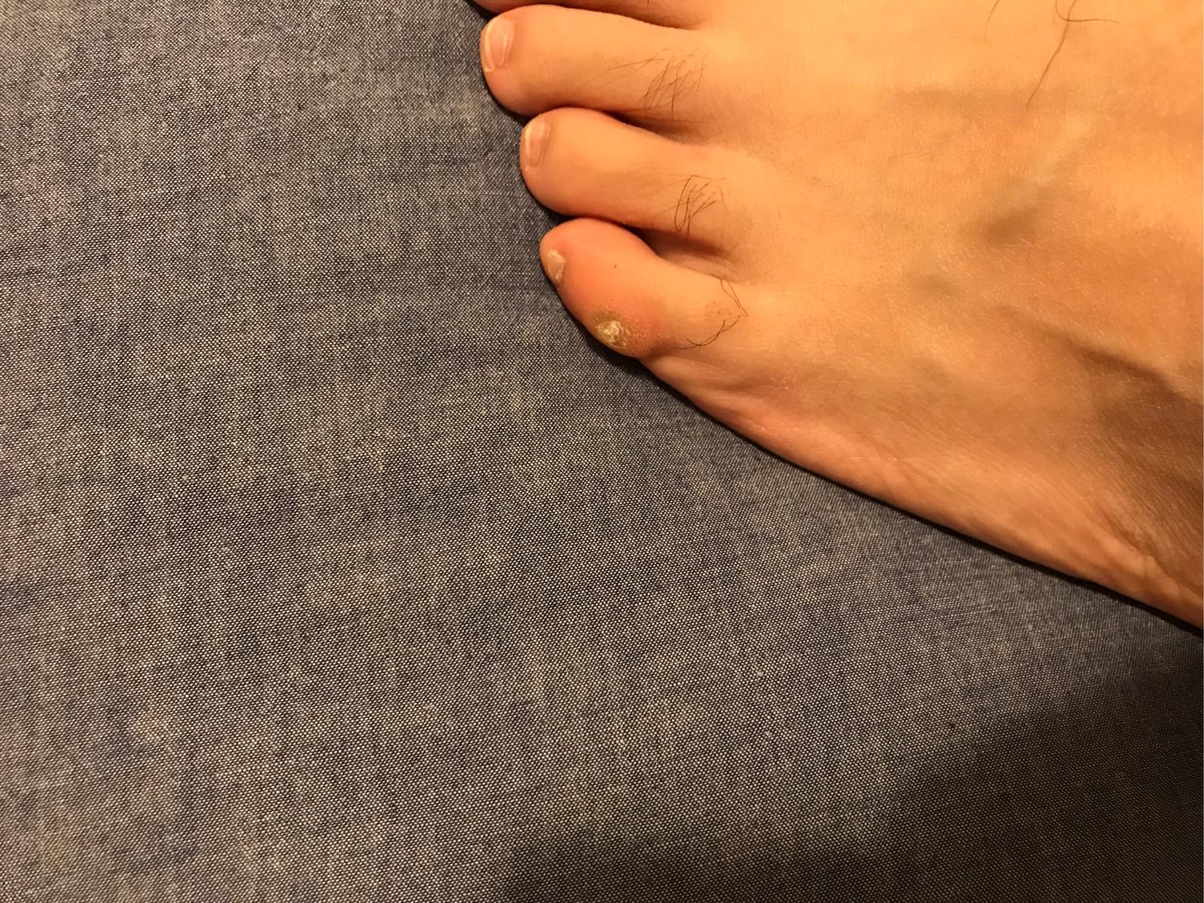 请问我小脚趾磨出的那个茧是鞋的问题还是我的脚问题