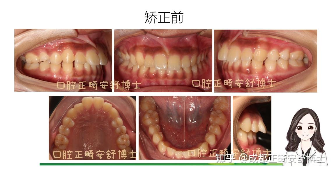 成都正畸成都牙齒矯正正畸會給側貌帶來多大的變化