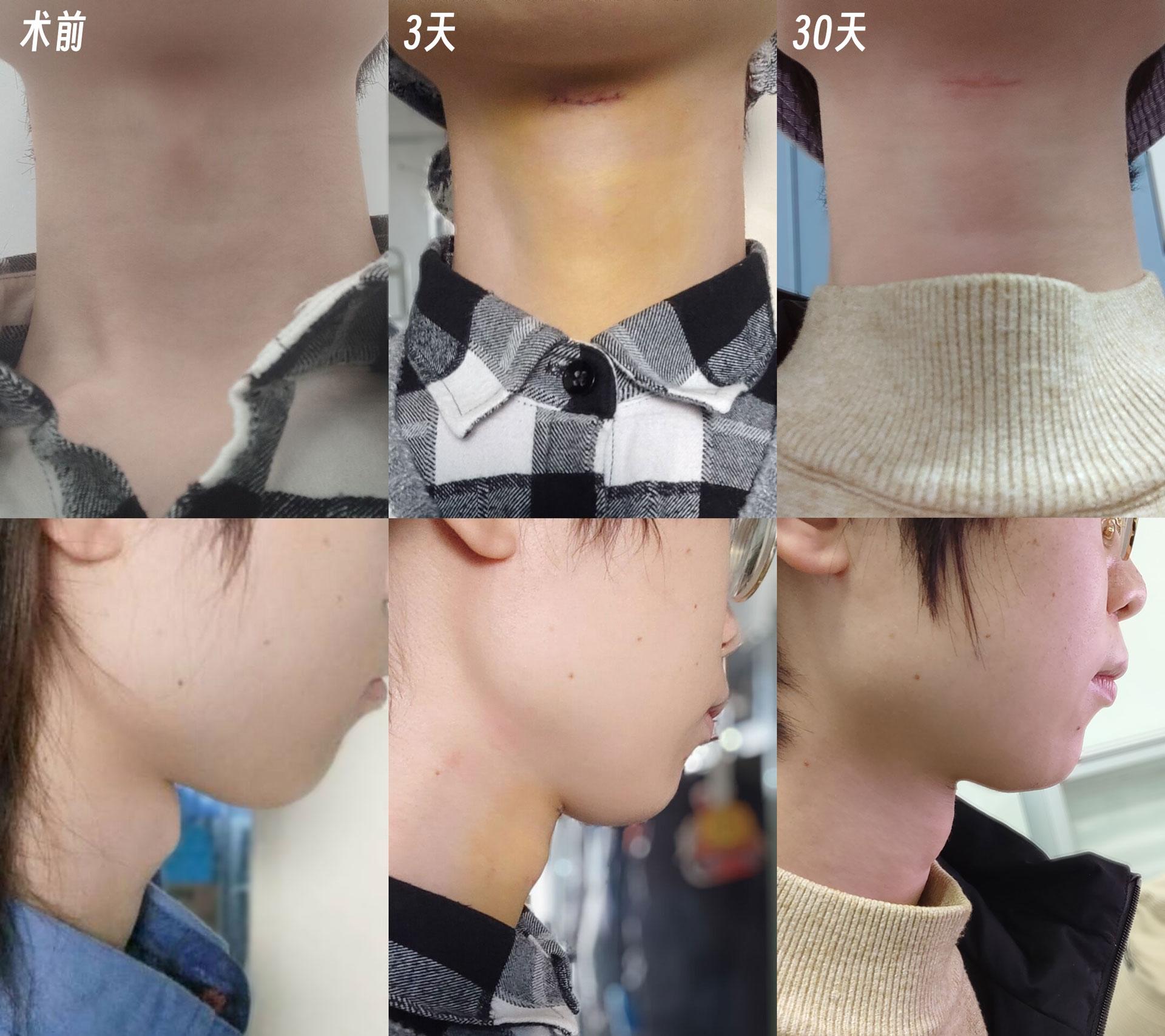 喉结消减手术哪家医院比较好?