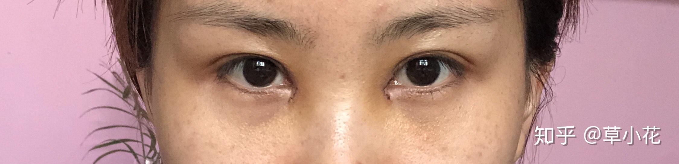 开眼角内眦赘皮记录