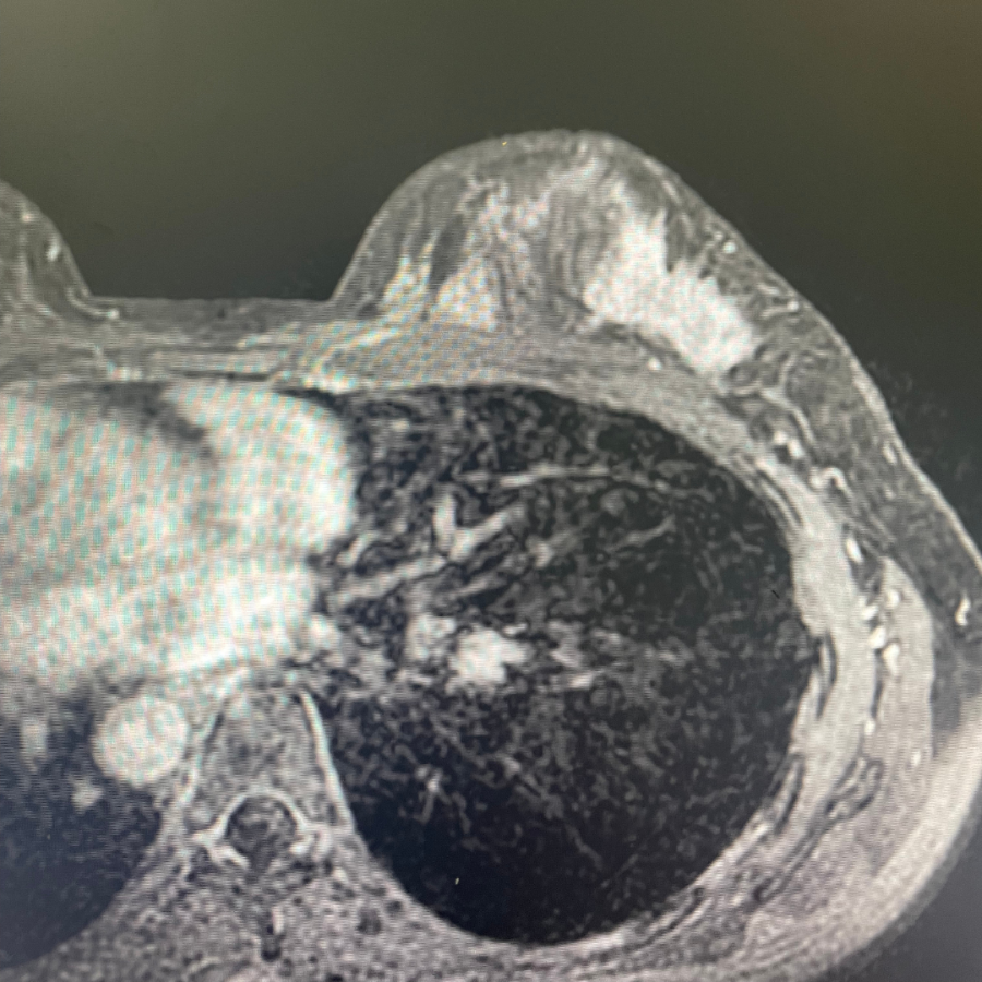 乳腺癌卫星结节图片图片