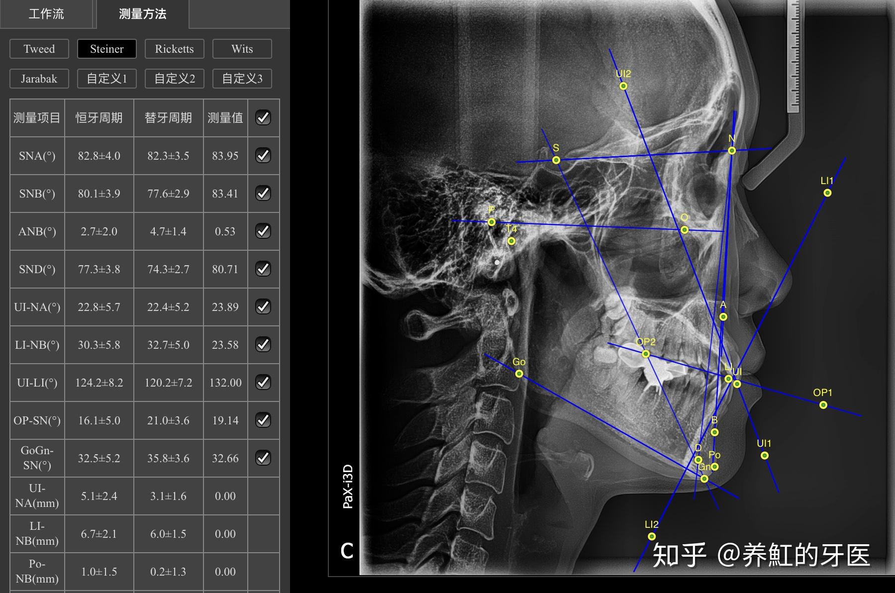 隐适美矫正骨型偏颌的病例分析