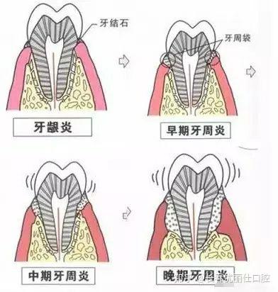 【科普】史上最详细的洗牙过程图解 知乎 