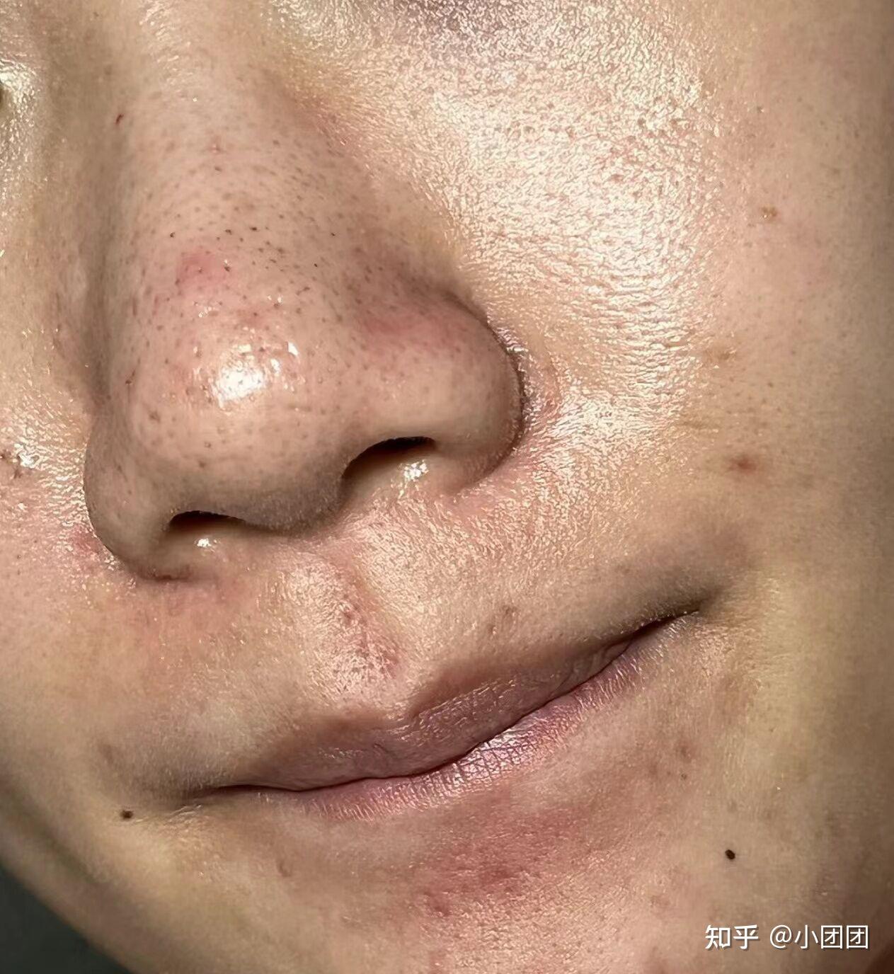 黑头满鼻子都是,恶心死了,你们的黑头都是怎么去掉的啊? - 知乎