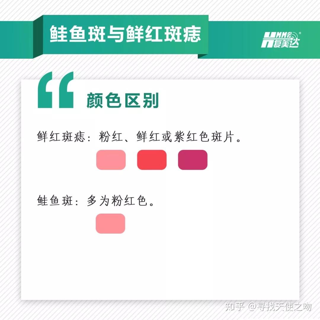 鲑鱼斑与鲜红斑痣:(左为鲑鱼斑)