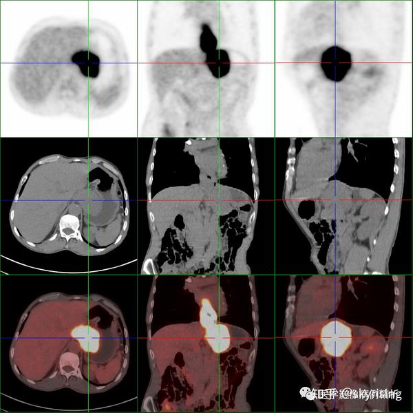 一文通读解析PET-CT检查所有注意事项、放射性危害及典型教学病例一例 - 知乎
