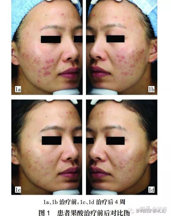 果酸换肤比你以为的更强大