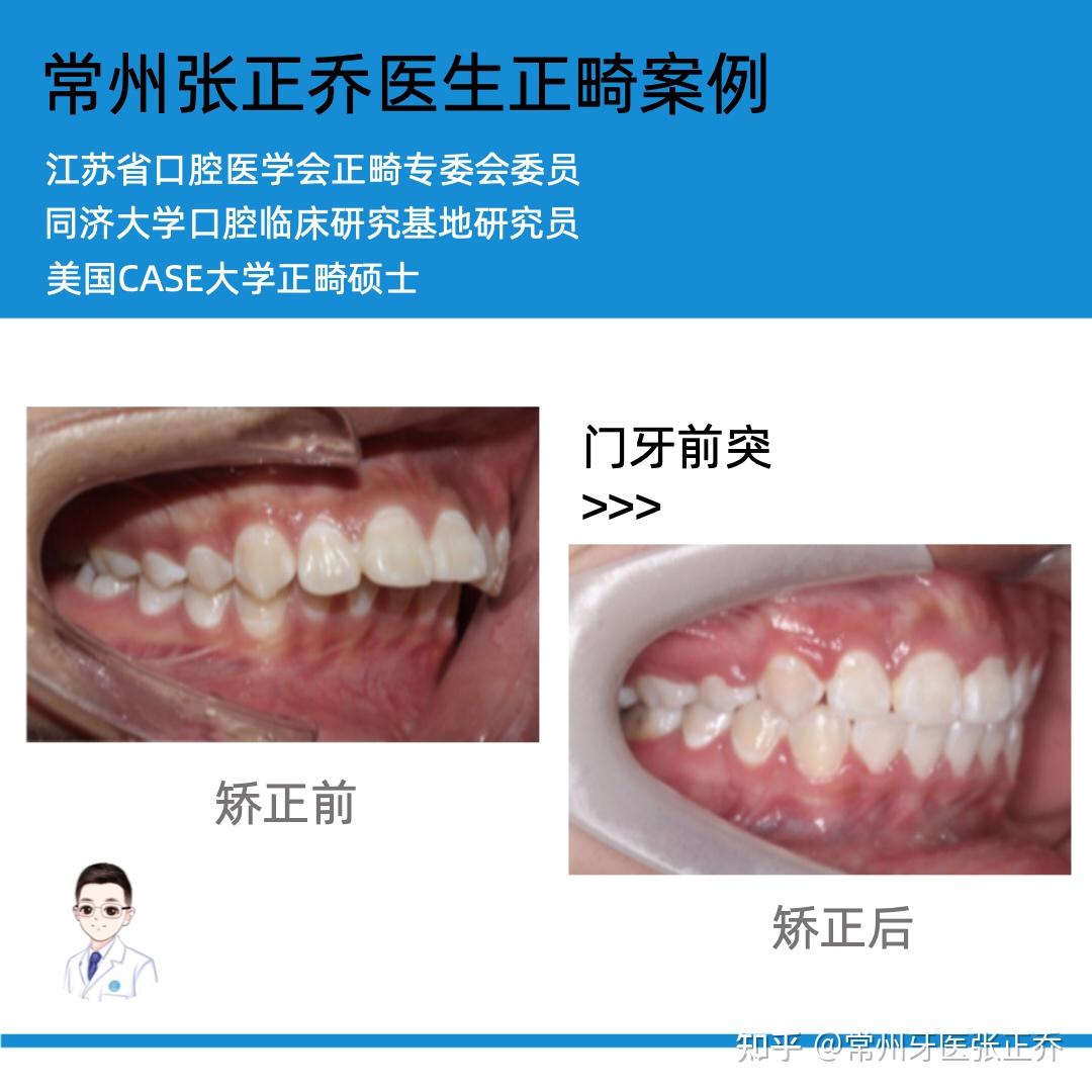 斯迈尔齿科 | 牙齿前突正畸案例分享_下颌