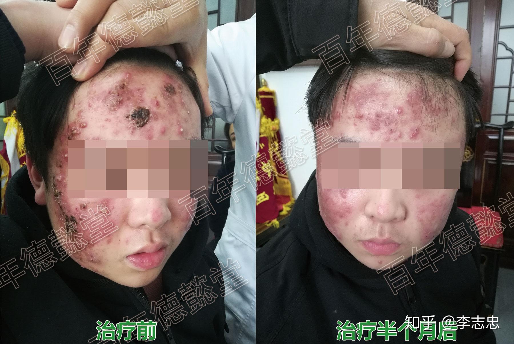 德懿堂治疗痤疮案例一则
