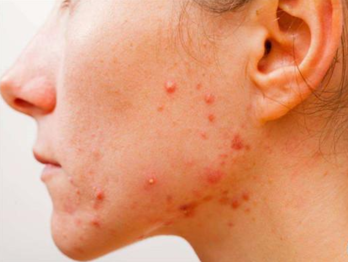 Acne Vulgaris
