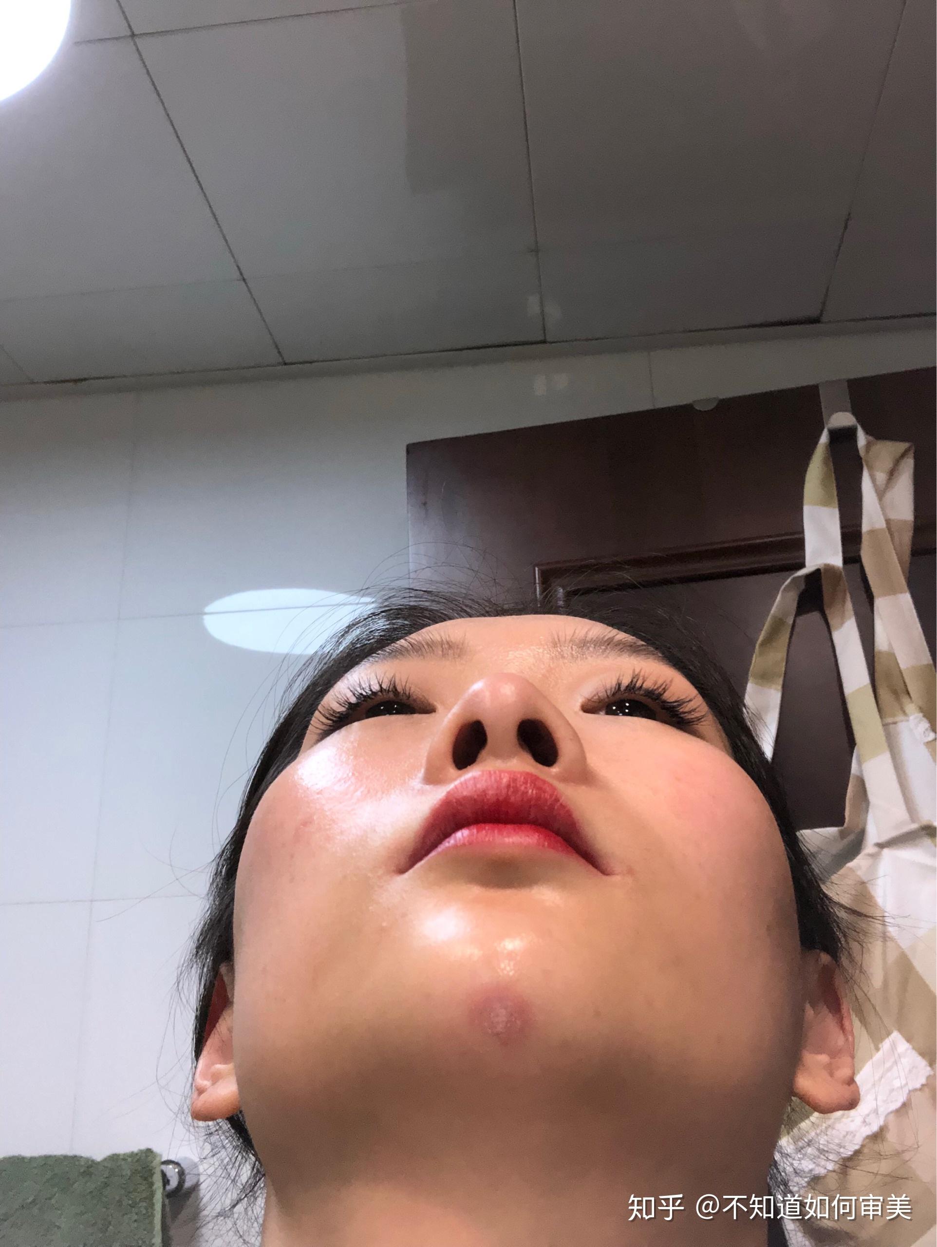 能不能帮我看看我这是打玻尿酸栓塞了吗