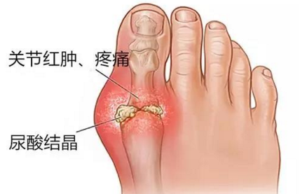 痛风止疼 以下这4个方法非常好用 知乎