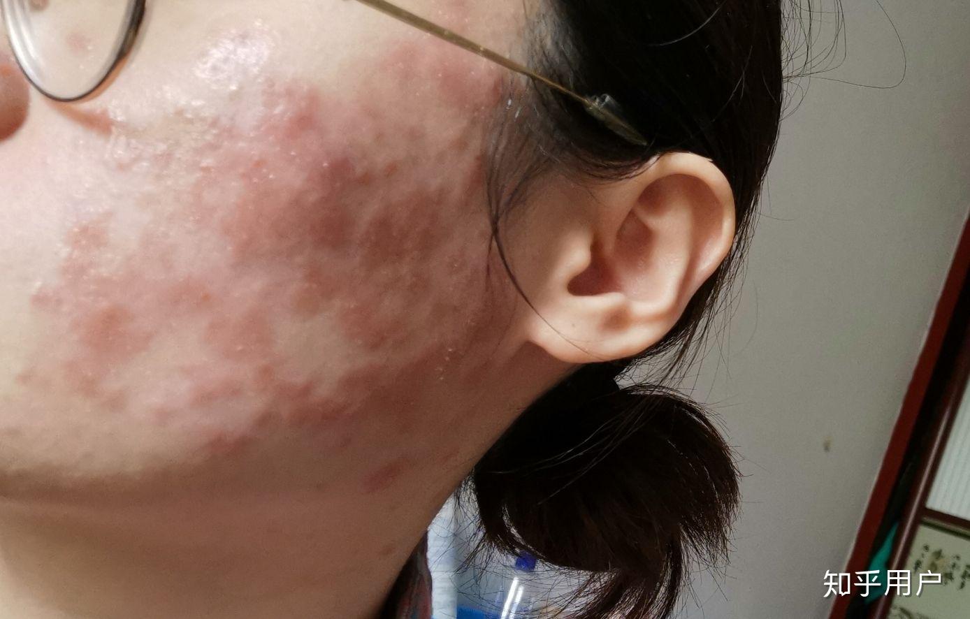 皮试过敏有什么反应? - 知乎