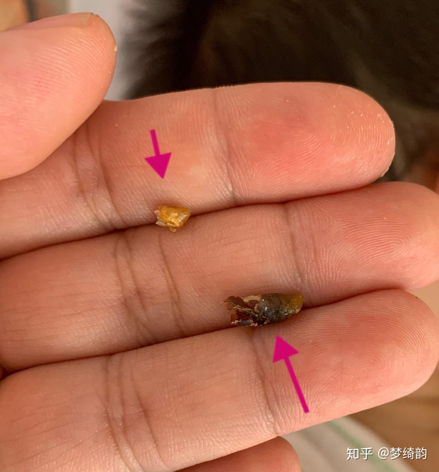 耳屎能大到什么程度