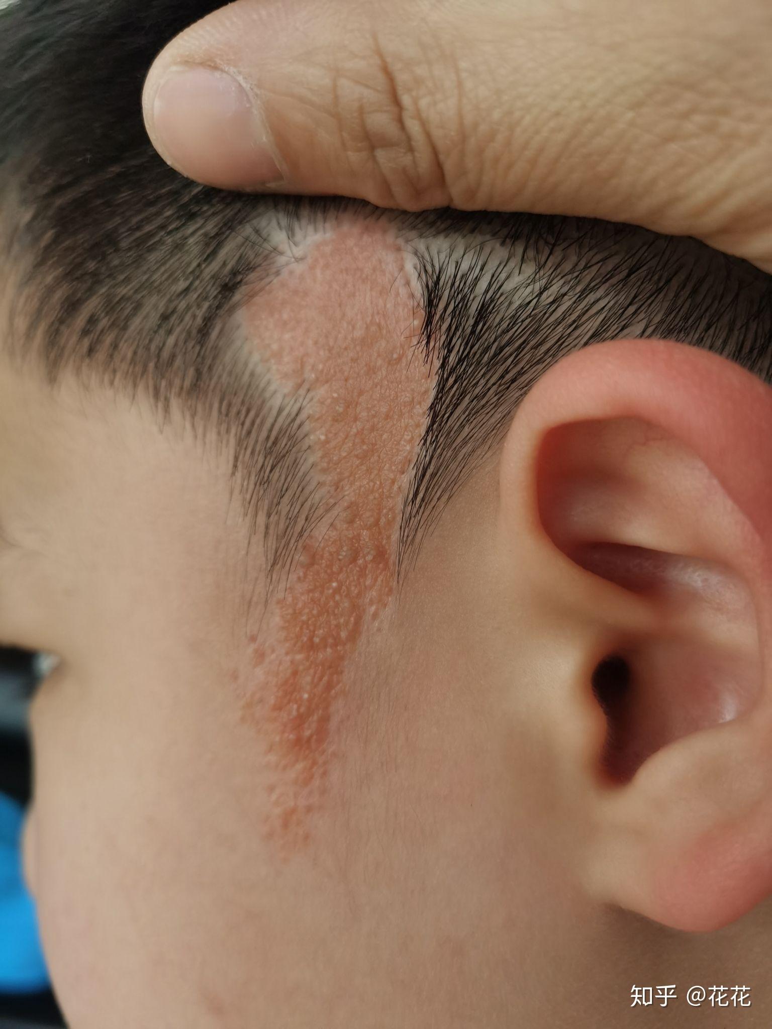 皮脂腺痣有什么好的治疗方案