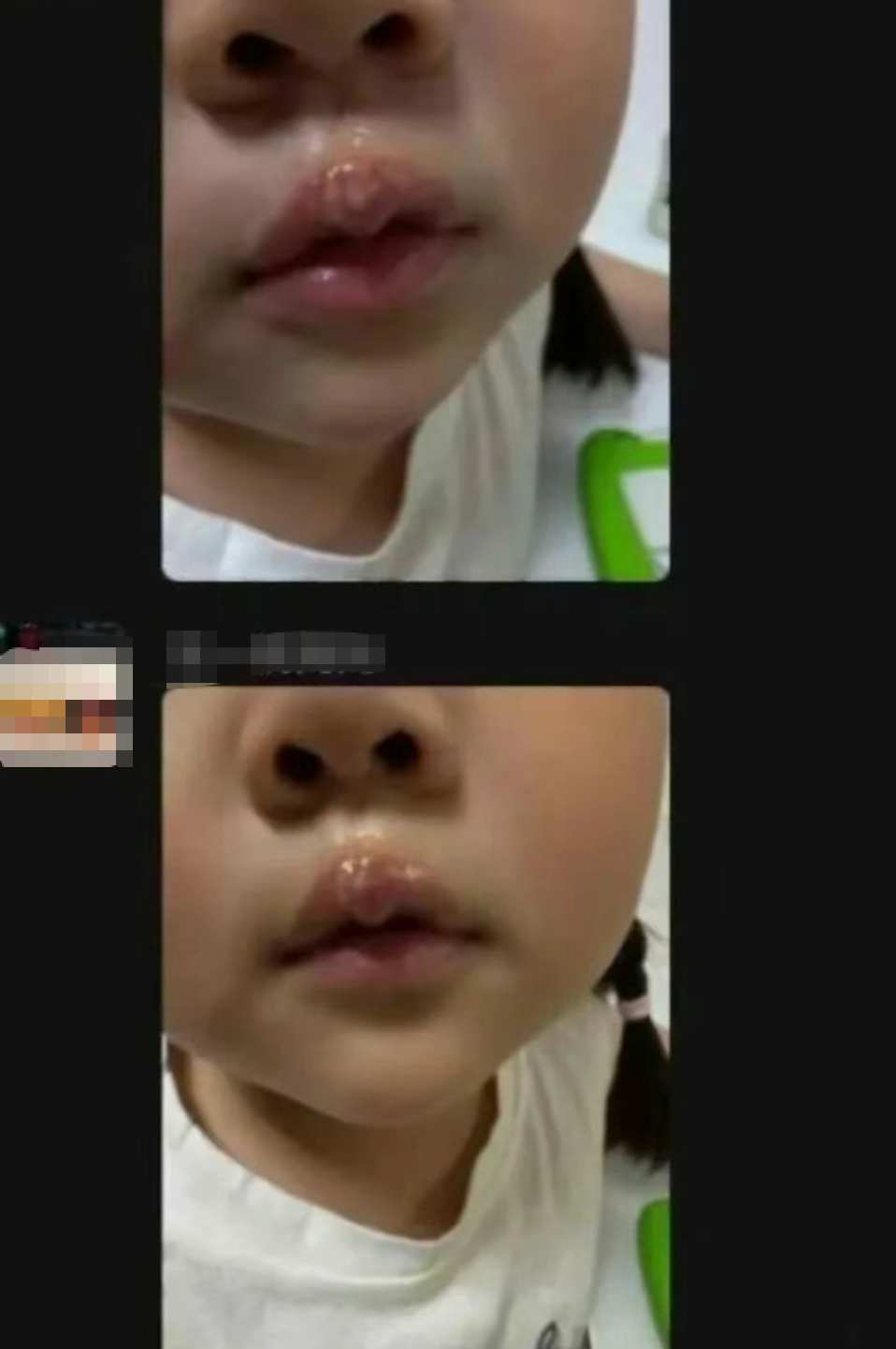 幼童被幼儿园老师用热熔胶烫嘴虐待，公安部门立案调查，此类虐童事件为何屡禁不止？背后哪些问题值得反思？