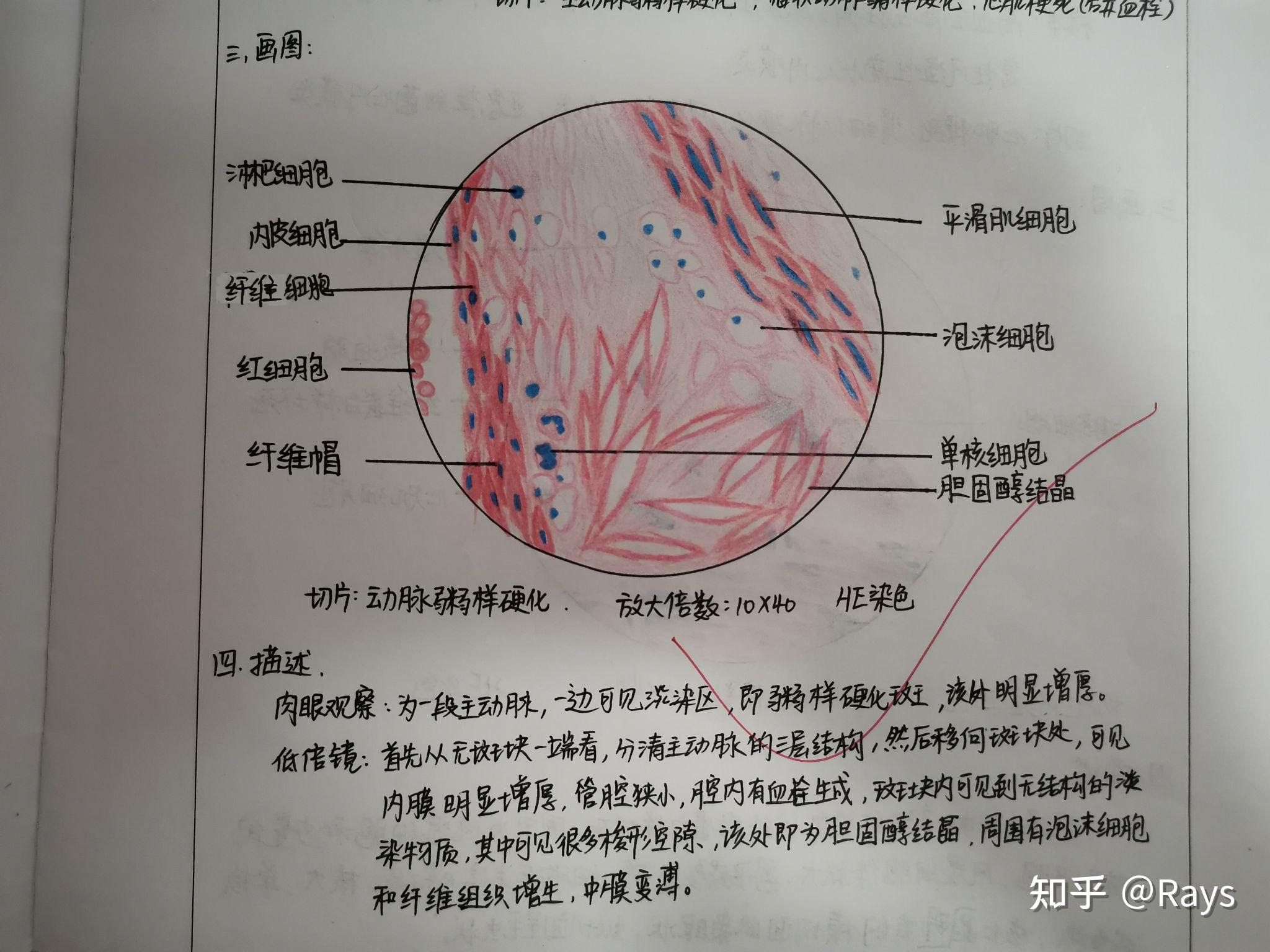 横纹肌肉瘤红蓝铅笔图图片