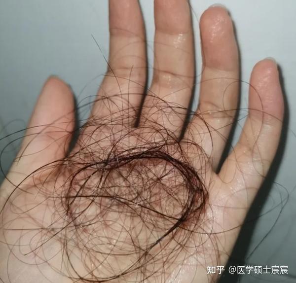 二,头发脆弱易断,经常掉发?