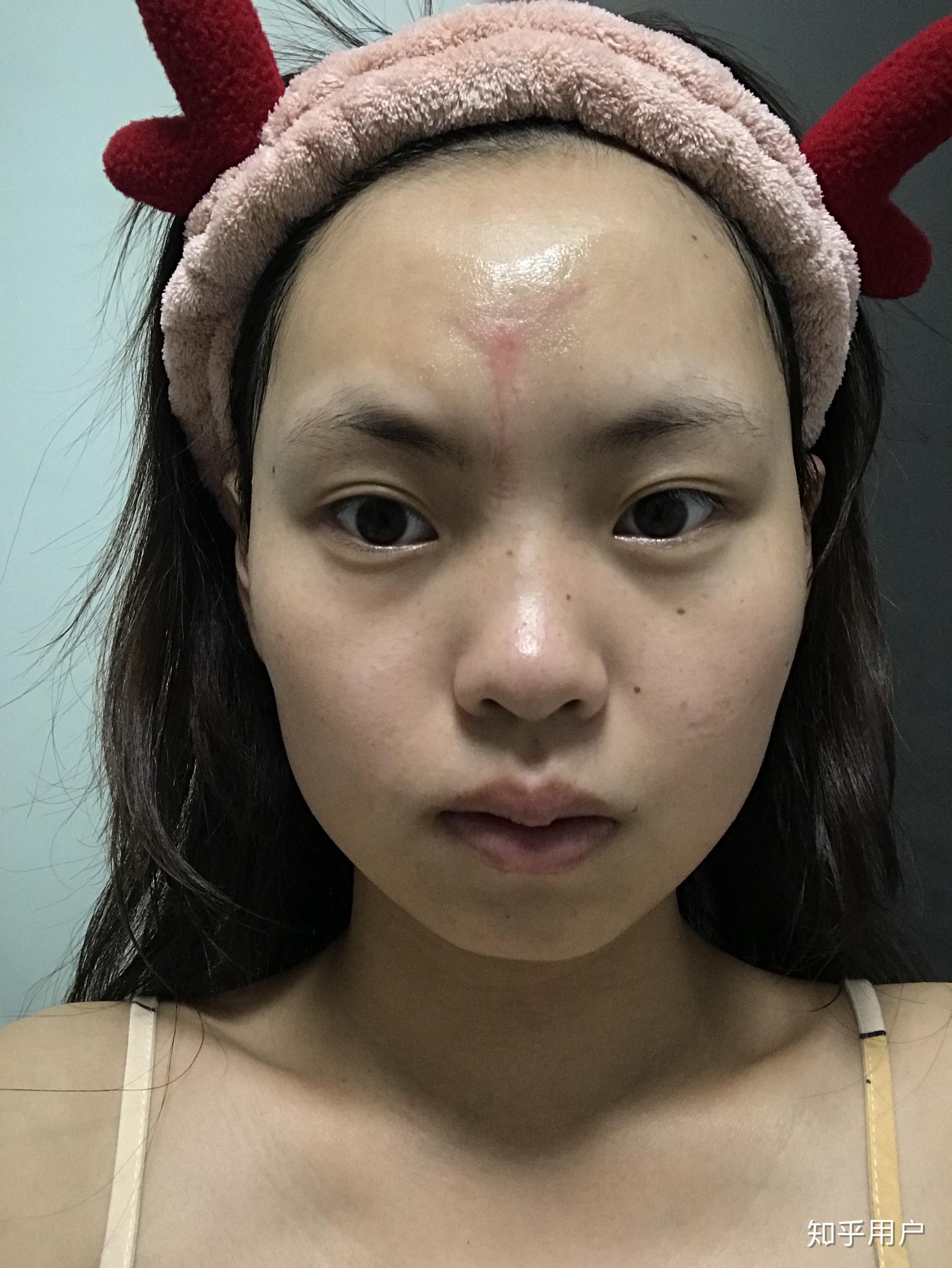 女生脸上有疤是怎样的体验? - 知乎