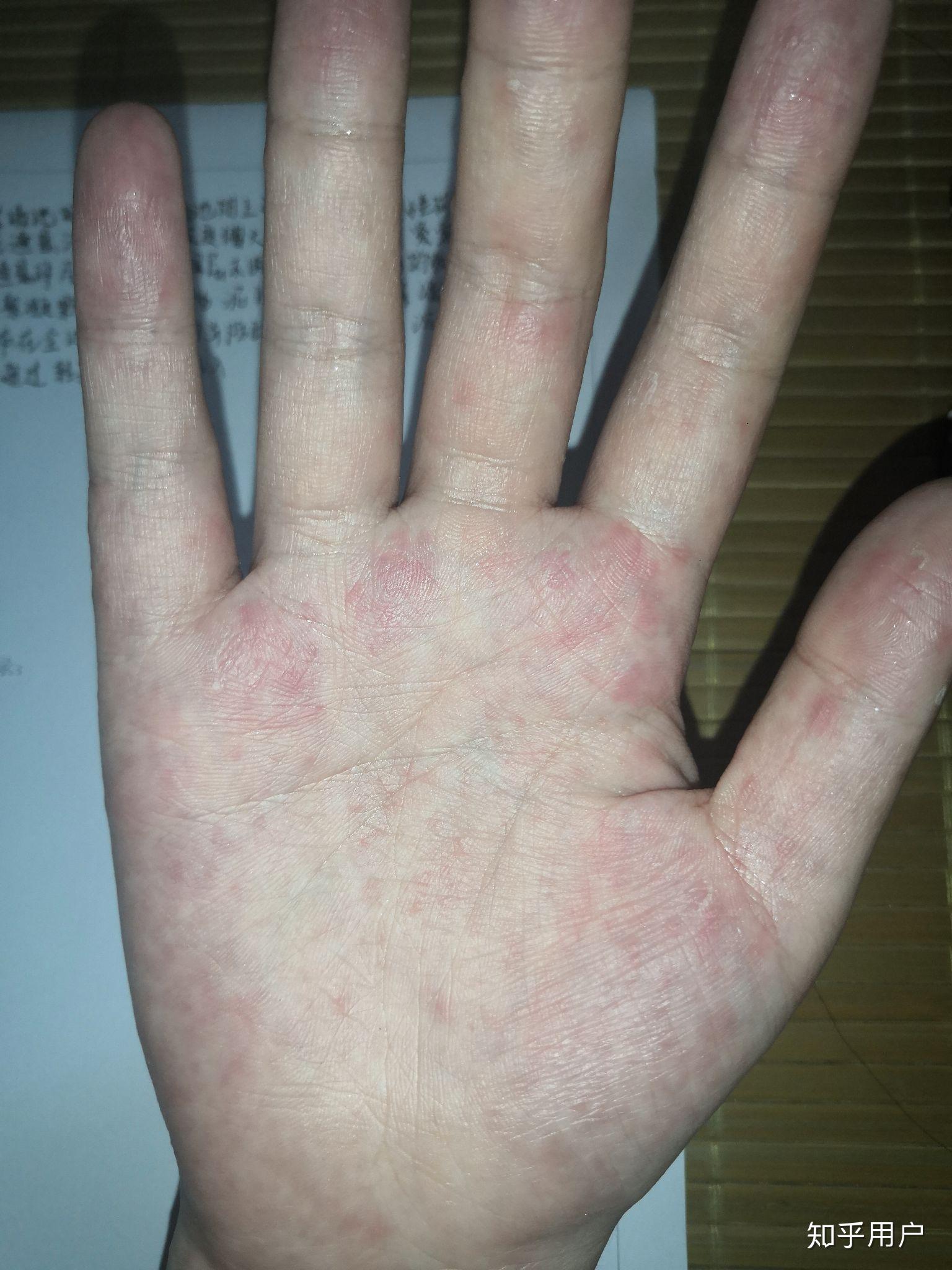出现红点和小水泡一样的东西有点痒,然后蜕皮越来越严重,有人说是血热