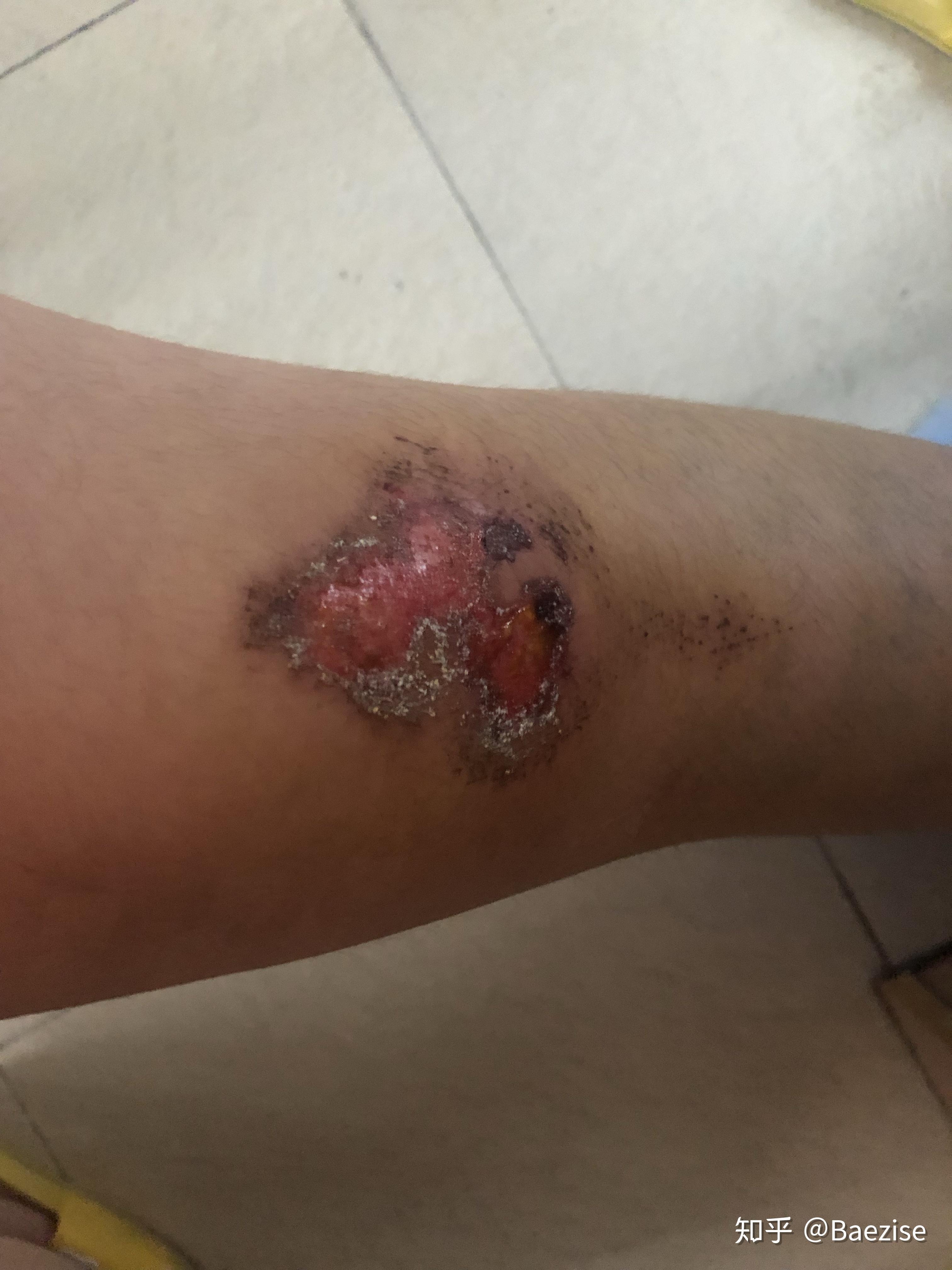 骑车侧翻膝盖摔伤破皮,怎么处理伤口,怎样才能不留疤? - 知乎