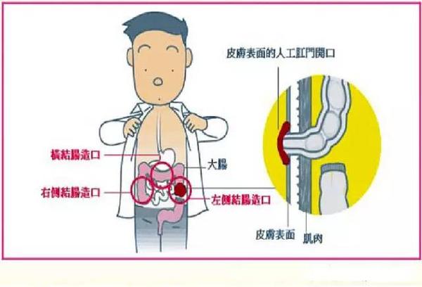 夏日炎炎，造口人的日常护理，你知道多少？ - 知乎