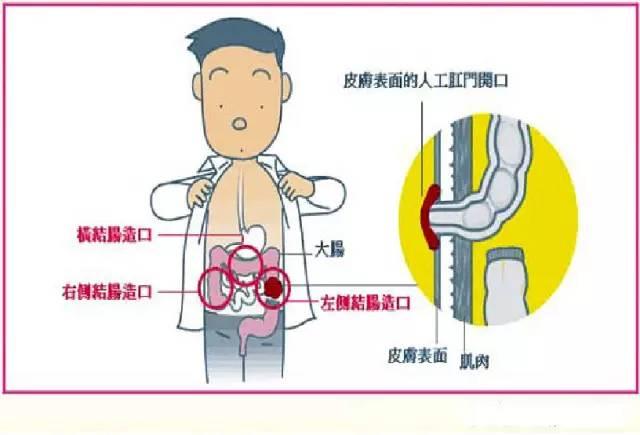 膀胱造瘘位置图图片