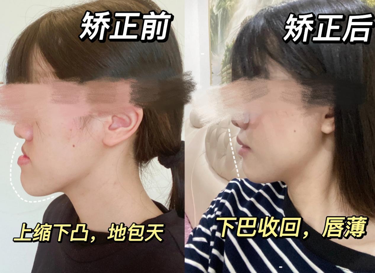 你的反颌(地包天)正畸矫正成功了吗? - 知乎