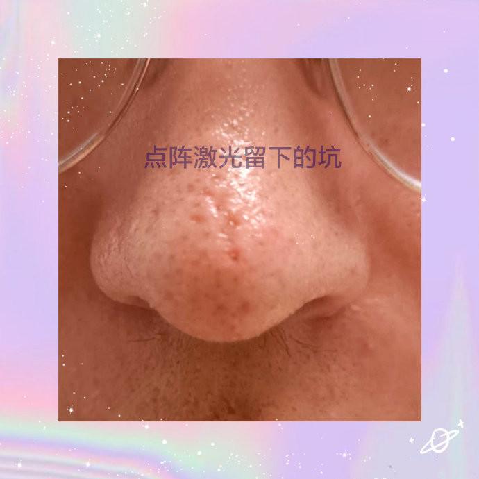 鼻子点阵激光导致了激光坑其中一个坑里有油脂粒会影响长肉吗该怎么把