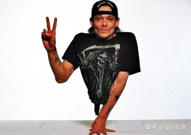 来自美国的肯尼是一个"半身人",当初在他年仅6个月时由于天生脊柱存在