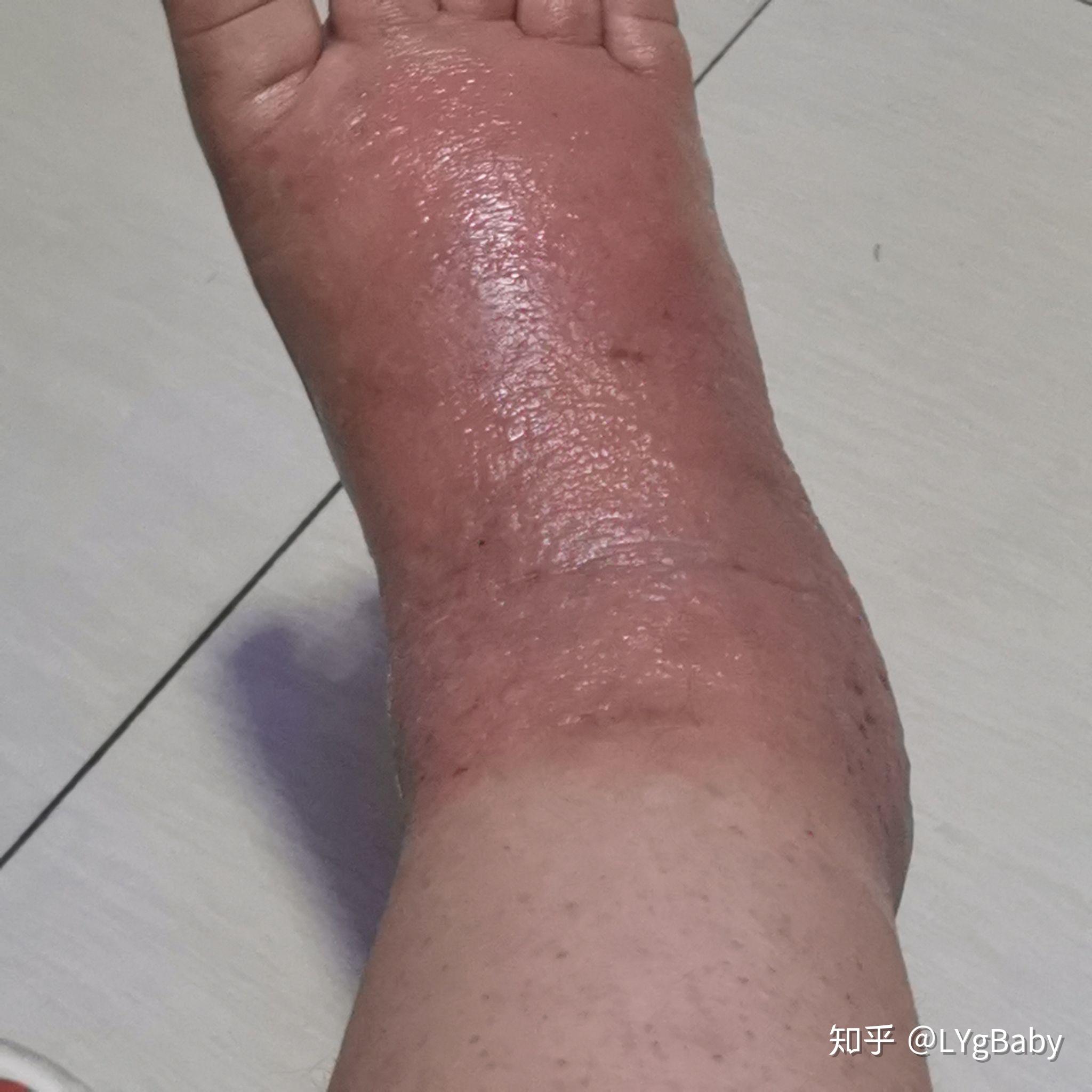 皮肤过敏起水泡怎么办