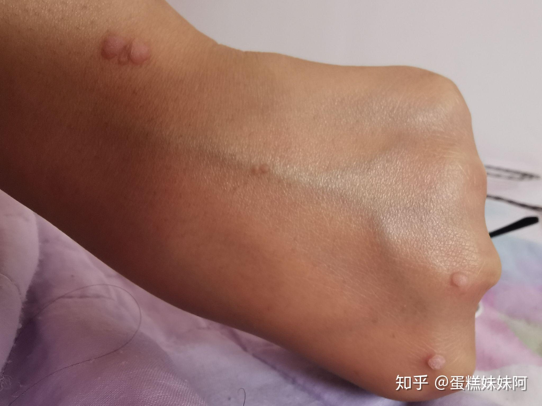 扁平疣记录我做冷冻的这段时间