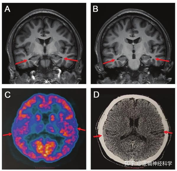 J Alzheimers Dis︱首都医科大学宣武医院贾建平团队报道世界第一例19岁阿尔茨海默病患者 - 知乎