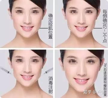 瘦脸针打一针有效果吗_瘦脸针打多少单位合适_瘦脸针怎么打
