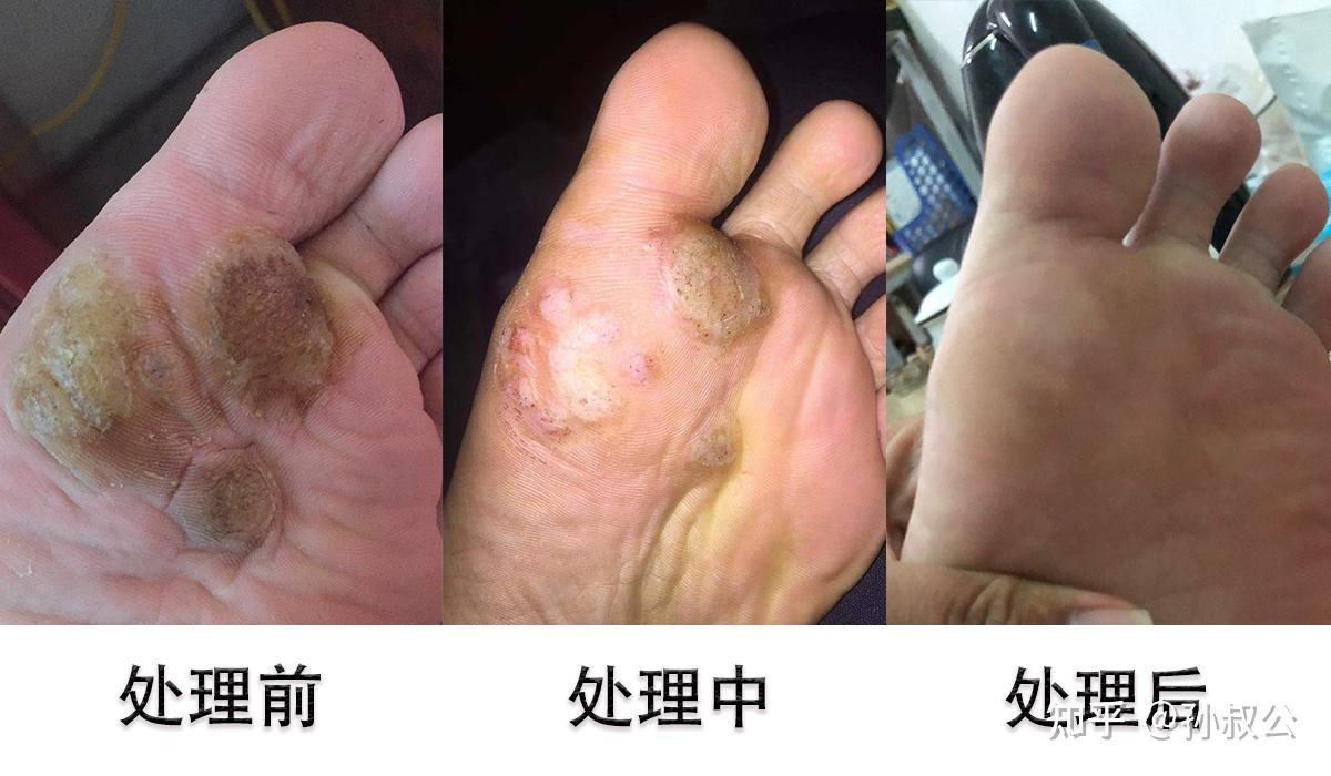 腳上長蹠疣能該怎麼辦