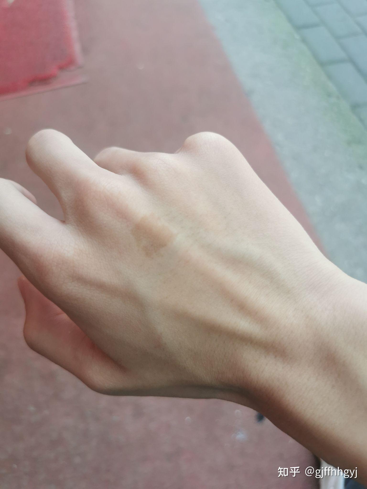 右手手背上有个胎记有什么寓意吗? - 知乎