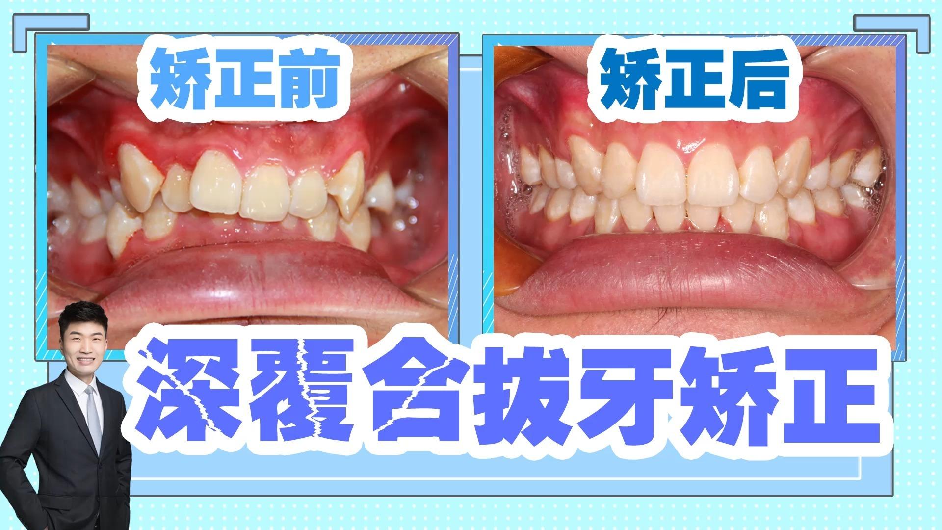 深覆合深覆盖隐适美矫正病例