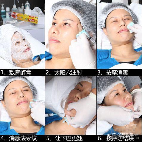 针,摒弃传统的五点式注射,反而一般采用八爪式注射法,来进行去皱提升