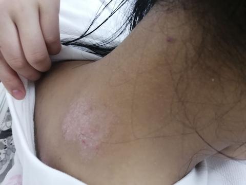 九日脖子后面长癣?像退了一成皮一样,比周围的皮肤白?