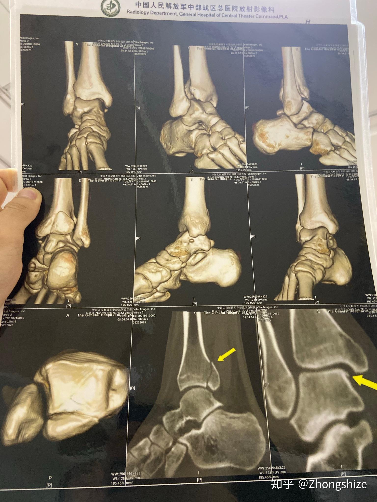 脚踝骨折三角韧带修复胫腓联合修复腓骨上段骨折