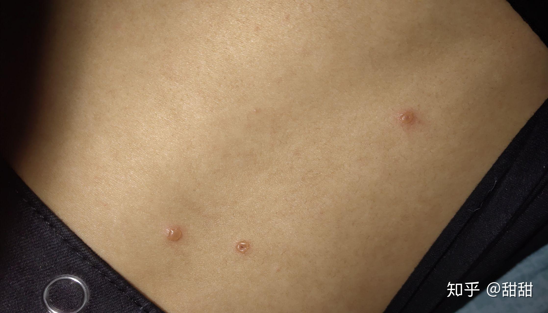 成人长水痘是什么样的经历? - 知乎