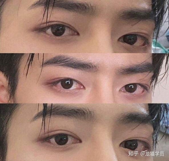 男生想要割双眼皮建议开眼角吗? - 知乎