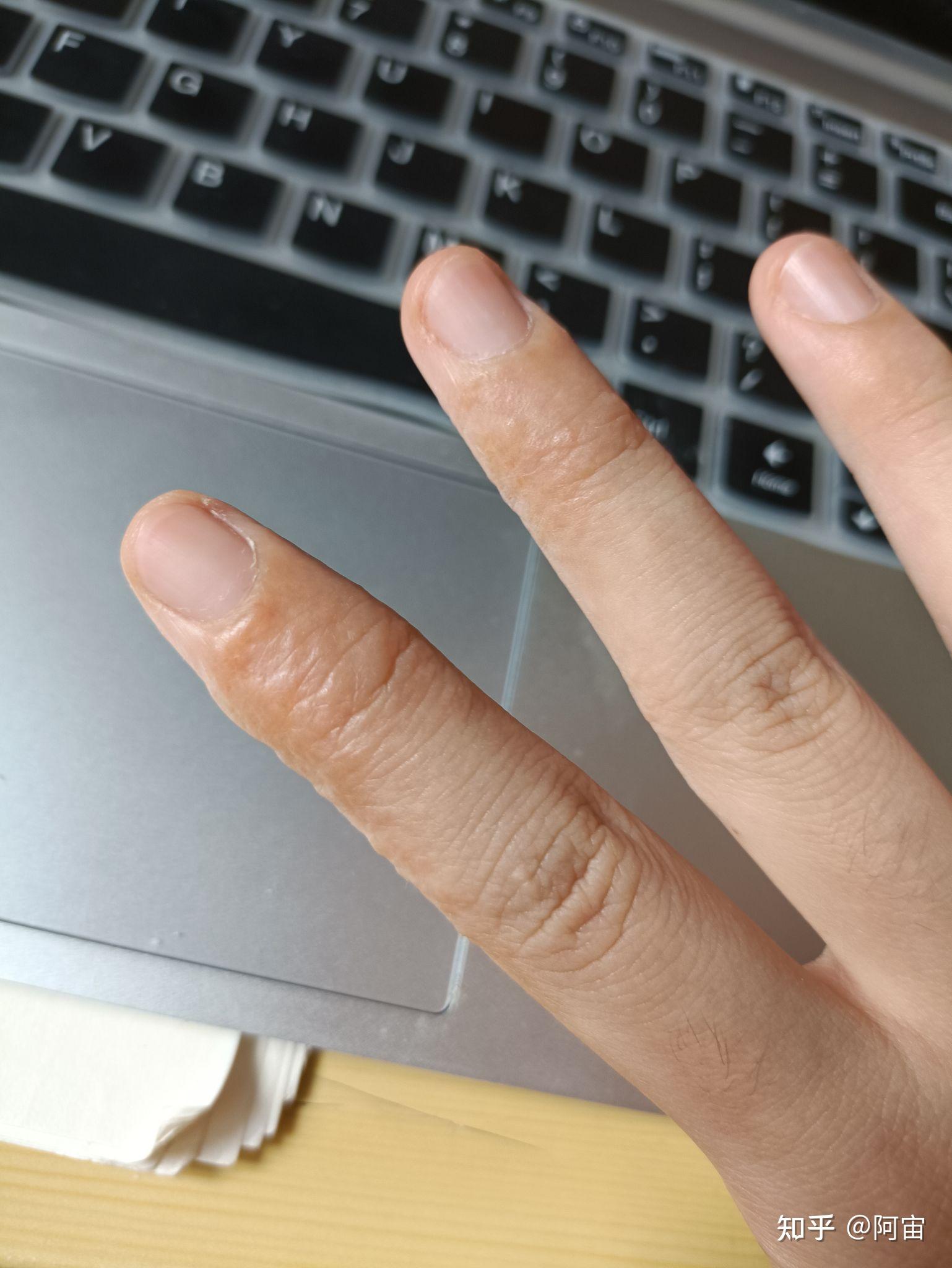 记录一次汗疱疹的痊愈过程