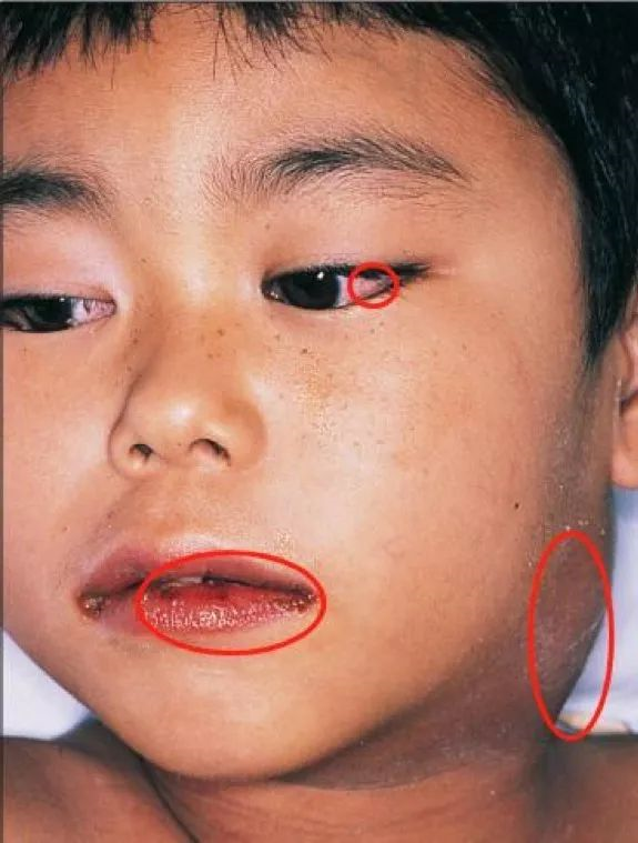 偏好儿童的血管炎病:川崎病(上) - 知乎