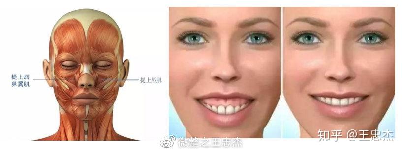 提上唇鼻翼肌过于发达,牵动上唇抬高,造成有深深的法令纹.