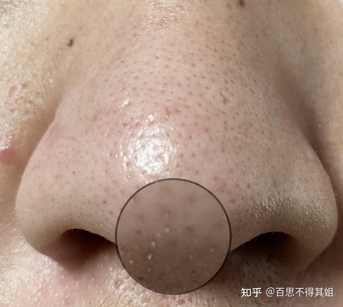 鼻子上挤出来的白色小颗粒是什么