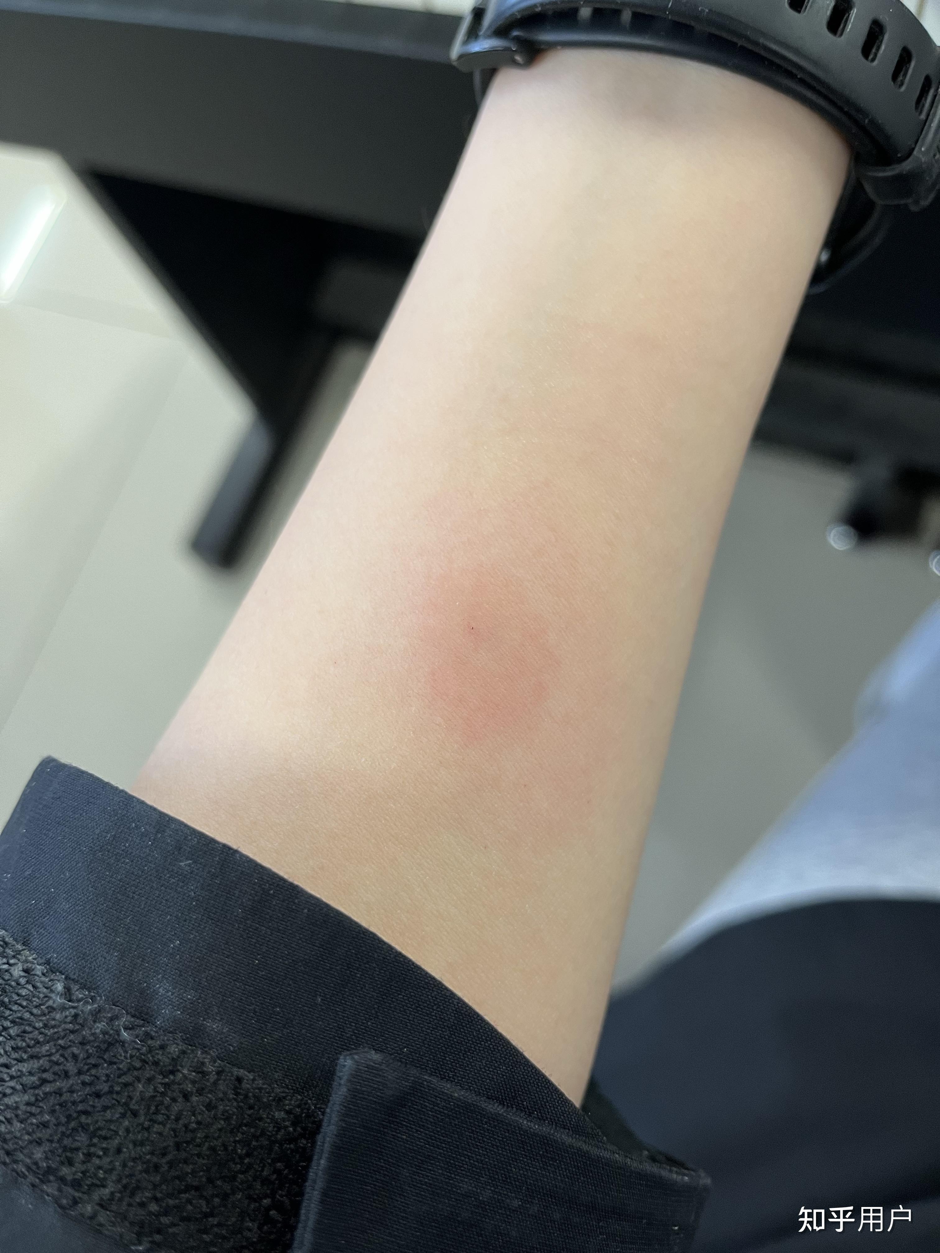 ppd皮试后这个样子怎么办? - 知乎