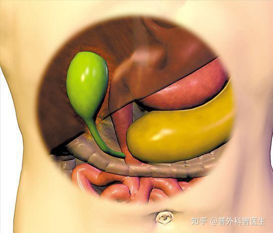 胆囊切除以后应该特别注意饮食 什么能吃 什么不能吃 知乎