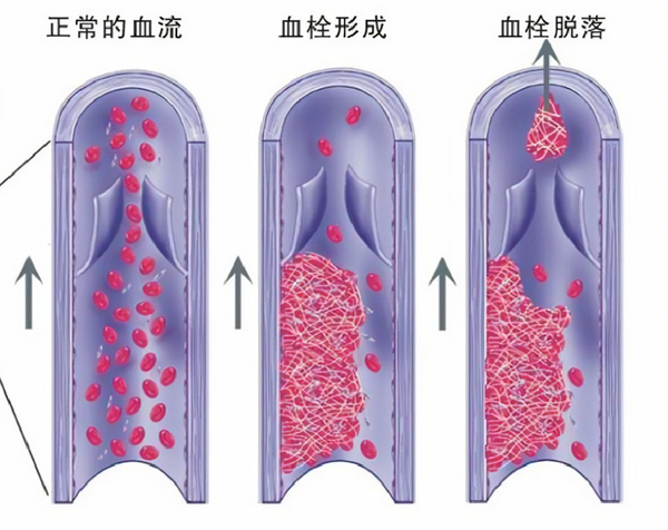 人工血管血栓原因 – 人工血管 穿刺方法 , 血流停滞による血栓形成のメカニズムを解明 – LGGBIM
